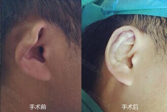 杯状耳.jpg